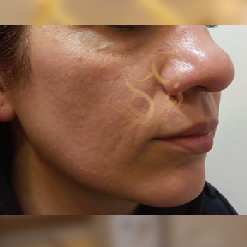 نمونه کار تزریق چربی صورت خانم محمدزاده