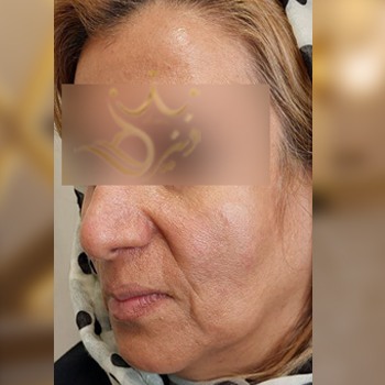 نمونه کار تزریق چربی صورت خانم پیمانی