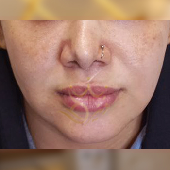 نمونه کار لیفت نخ صورت خانم قربانی