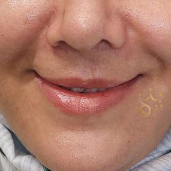 ژل لب در مشهد خانم رزمی