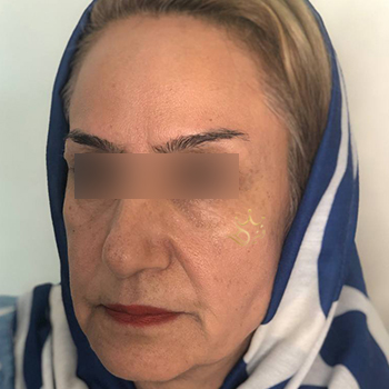 تزریق چربی صورت در مشهد خانم نیکومنش