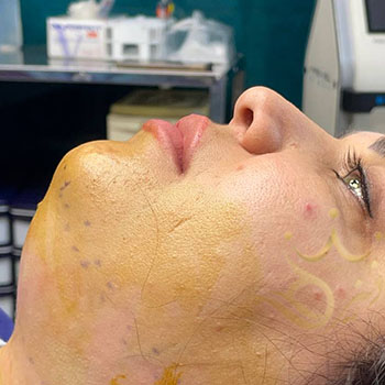 ساکشن غبغب در مشهد خانم صارمی