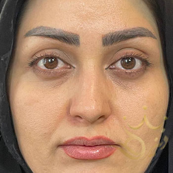 کاشت ابرو در مشهد خانم براتی