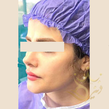 تزریق چربی صورت در مشهد خانم اختری