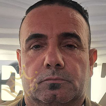 تزریق چربی صورت در مشهد آقای داداشی