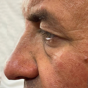 بلفاروپلاستی در مشهد آقای مسعود شاکری