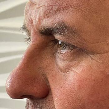 بلفاروپلاستی در مشهد آقای مسعود شاکری