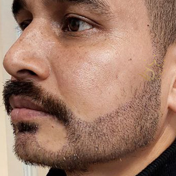 کاشت ریش در مشهد آقای اکبرزاده