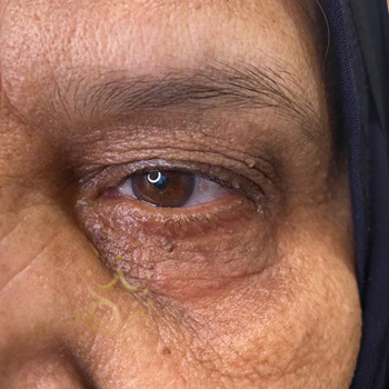 بلفاروپلاستی در مشهد خانم یوسفی