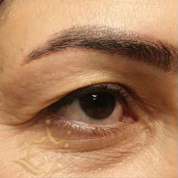 بلفاروپلاستی در مشهد خانم فاطمی