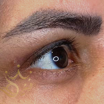 بلفاروپلاستی در مشهد خانم طاهری