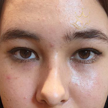 بلفاروپلاستی در مشهد خانم اقبالی بیدگلی