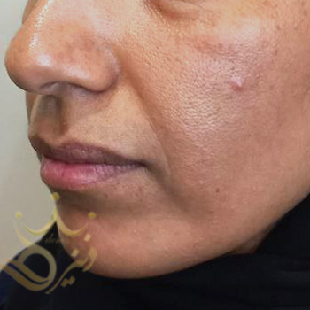 تزریق چربی صورت در مشهد خانم بهناز پاک نژاد