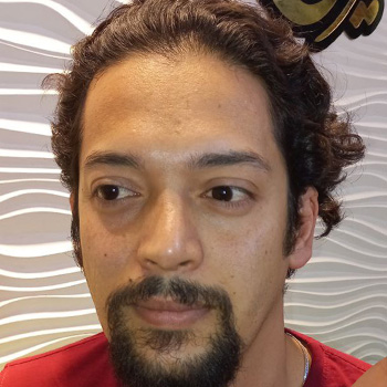 کاشت ریش در مشهد آقای بزرگ نیا