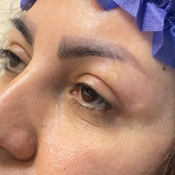کاشت ابرو در مشهد خانم سامتی