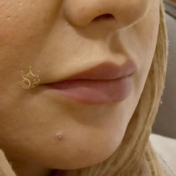 ژل لب در مشهد خانم عاطفه آریش