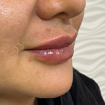 ژل لب در مشهد خانم عاطفه آریش