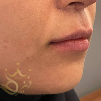 ژل لب در مشهد خانم رستم نژاد