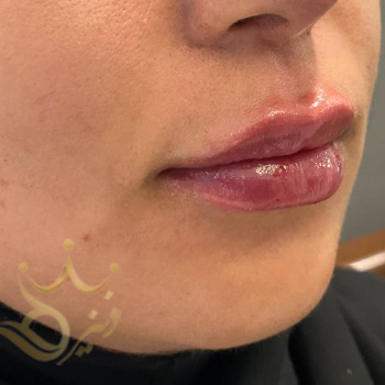 ژل لب در مشهد خانم رستم نژاد