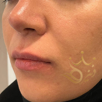 ژل لب در مشهد خانم کاظمی