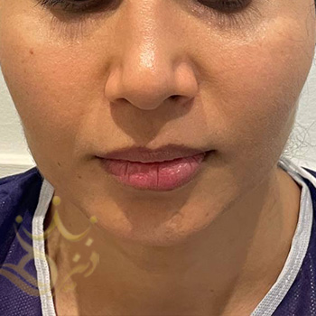 تزریق چربی صورت در مشهد خانم آجمیان