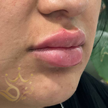 ژل لب در مشهد خانم باقری