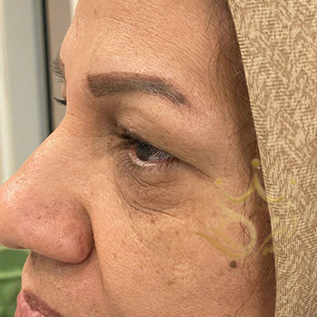 بلفاروپلاستی در مشهد خانم ذاکری