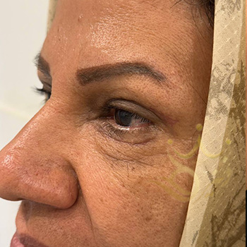 بلفاروپلاستی در مشهد خانم ذاکری