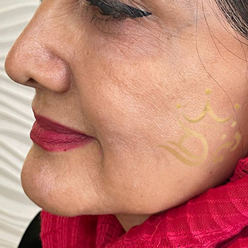 تزریق چربی صورت در مشهد خانم دلشاد