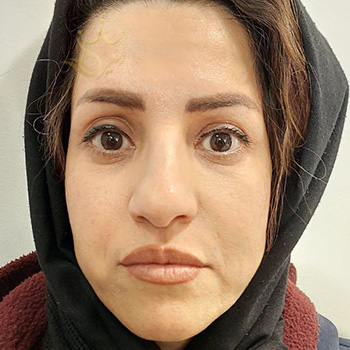 تزریق چربی صورت در مشهد خانم سرلک