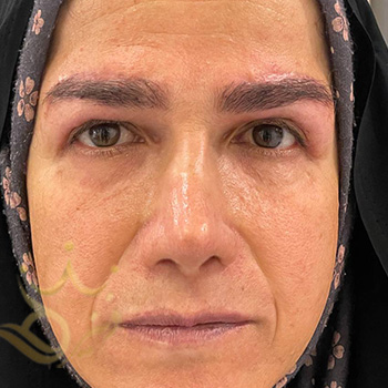 کاشت ابرو در مشهد خانم سورانی