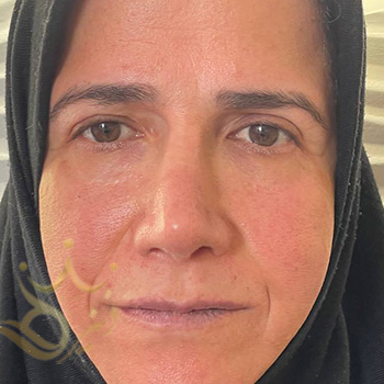 کاشت ابرو در مشهد خانم سورانی