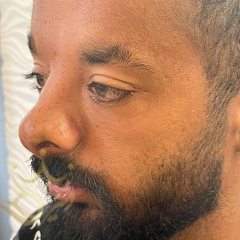 کاشت ابرو در مشهد آقای غلامی