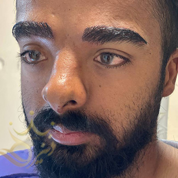 کاشت ابرو در مشهد آقای غلامی