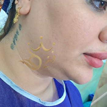 ساکشن غبغب در مشهد خانم رحمانی