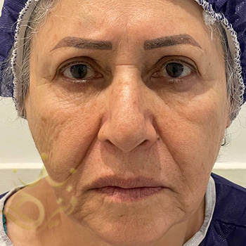 تزریق چربی صورت در مشهد خانم نیک نژاد