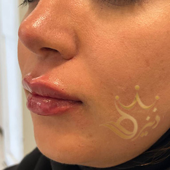 ژل لب در مشهد خانم کاظمی