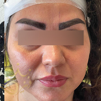 کاشت ابرو در مشهد خانم کابلی