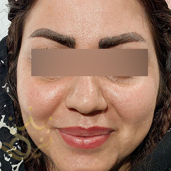 کاشت ابرو در مشهد خانم کابلی