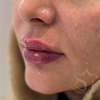 ژل لب در مشهد خانم کدخدایی