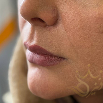 ژل لب در مشهد خانم کدخدایی