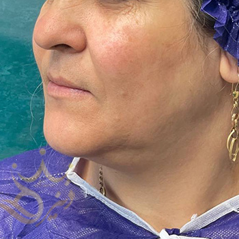 ساکشن غبغب در مشهد خانم یساقی