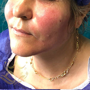 ساکشن غبغب در مشهد خانم یساقی