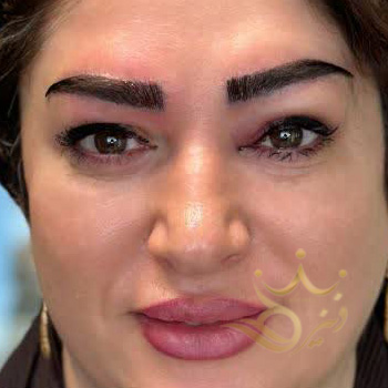 کاشت ابرو مشهد خانم غلامی