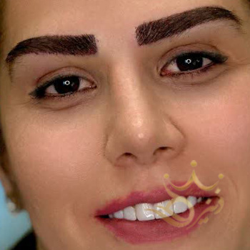 کاشت ابرو مشهد خانم ترکاشوند